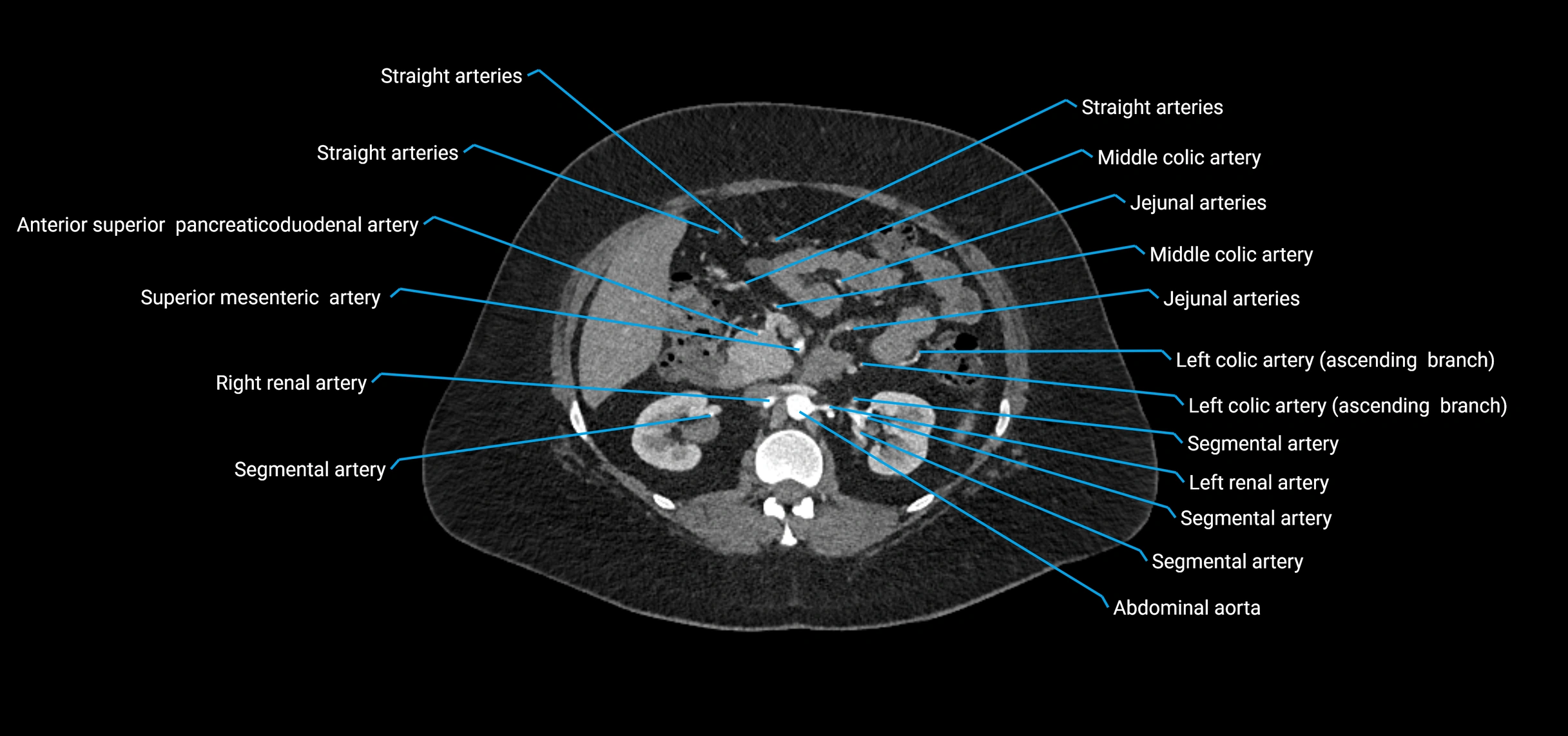 CTA abdomen axial cross sectional anatomy labelled image_72 (2).webp